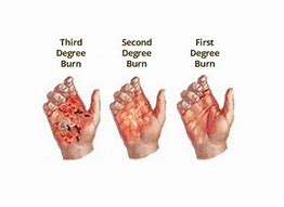 skinburns
