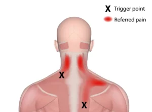 myofascial pain injury