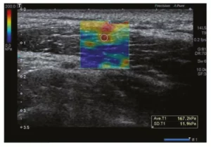 myofascial pain injury