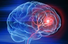 stroke1